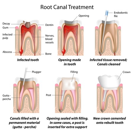dental travel root canal therapy